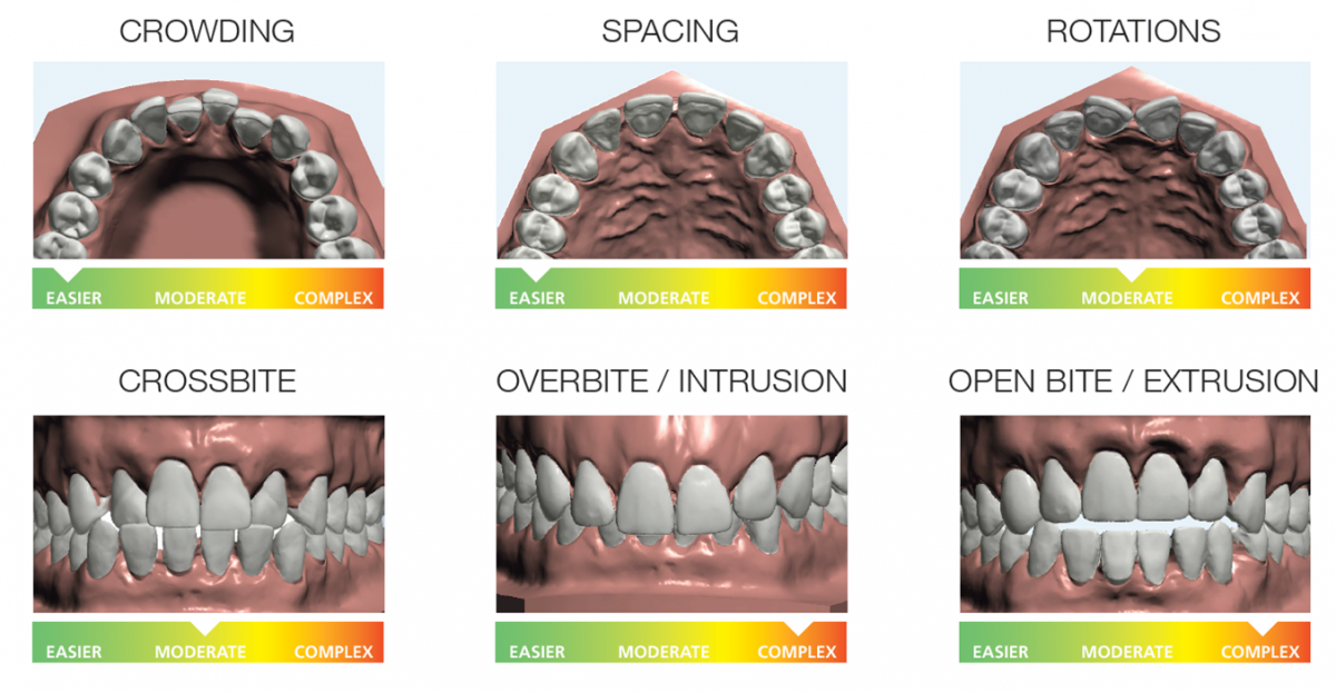 Benefits of Invisible Teeth Aligners Surrey BC - Teeth Alignment